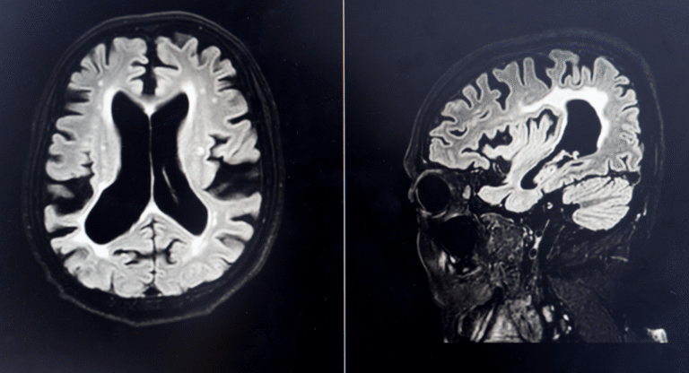 A Sense of Purpose May Help Delay Cognitive Decline