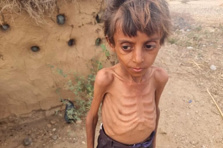 How hunger is devastating Yemen’s children